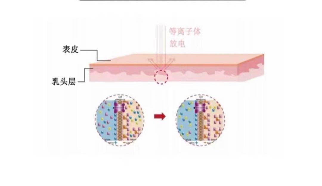 最新版　プラズマペン　繰り返すニキビ肌に　肌荒れに　業務用・セルフok