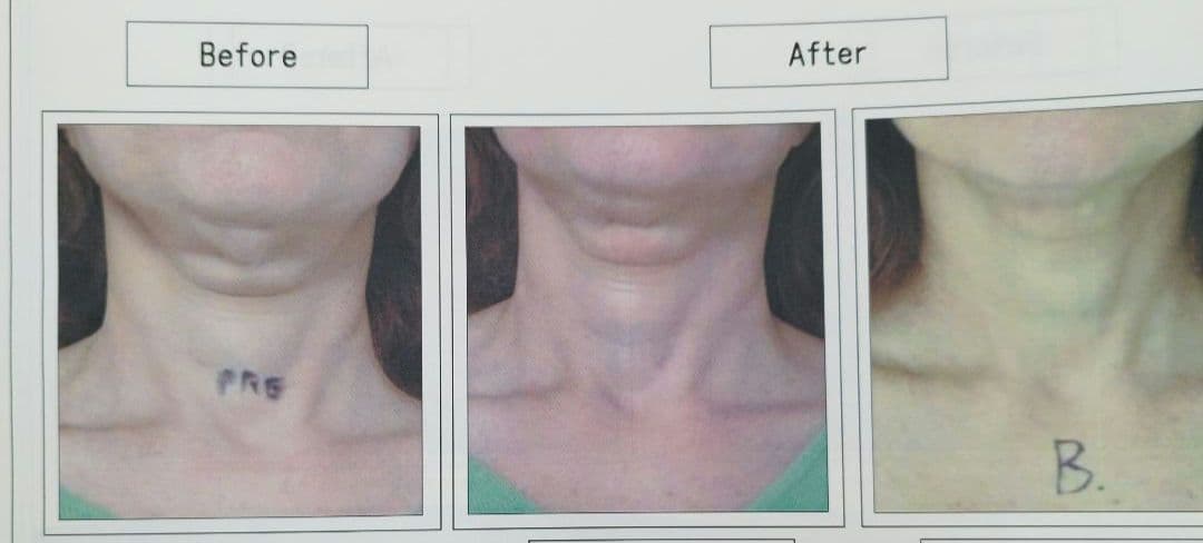 業務用 ラジオ波 エステマシン トライポーラ RF　値下げ交渉有り