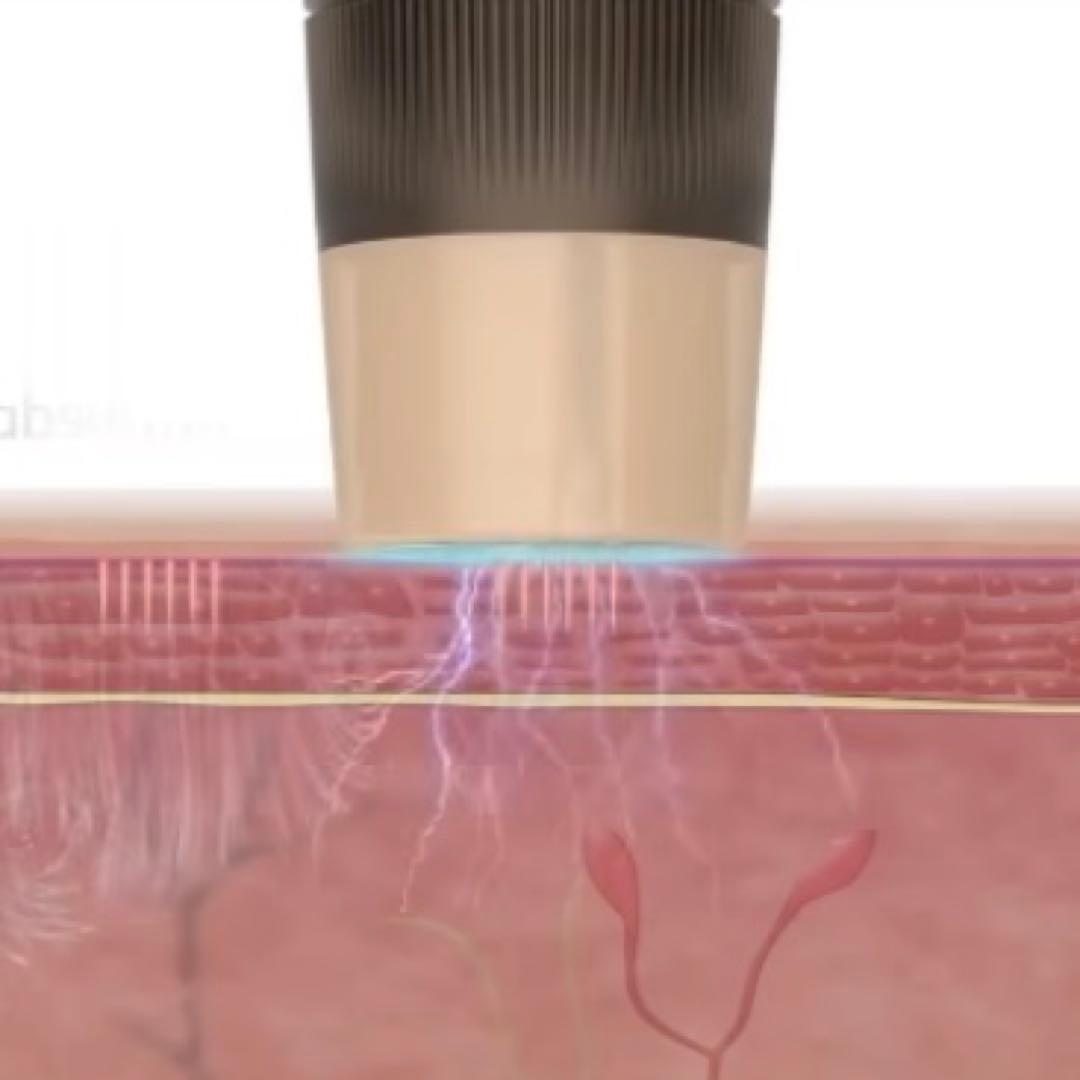 ao 最新EMS付きマイクロニードルペンとチップ30個付き